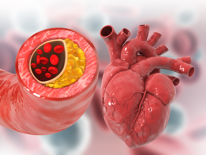 Okklusion af hjerte grundet forhøjet kolesterol