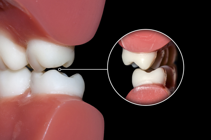Okklusion, hvor tænderne mødes eller griber skævt